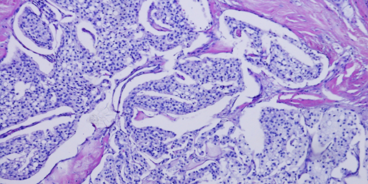 Microscopic view of tissue stained with haematoxylin and eosin, showing clusters of small, dark purple cells and areas of pink extracellular matrix, commonly seen in histology slides.