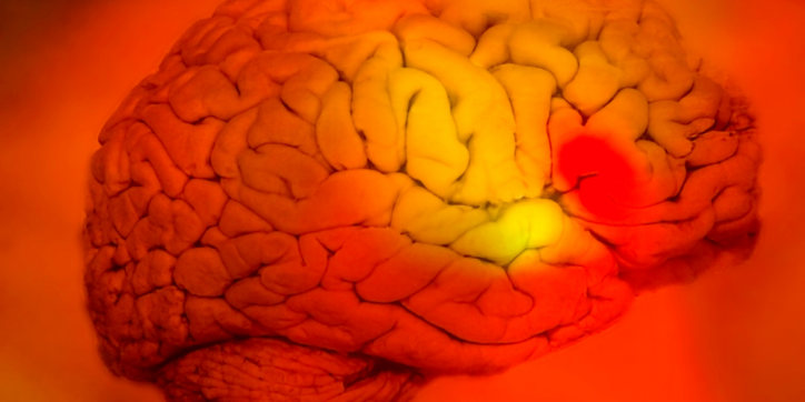 A human brain shown in shades of orange and yellow, with a prominent red spot highlighting an area of concern or injury on the right-hand side.