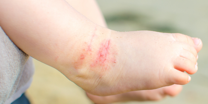 Close-up of a child's foot and ankle showing red, irritated skin with visible scratches and mild swelling, suggesting a rash or skin irritation.