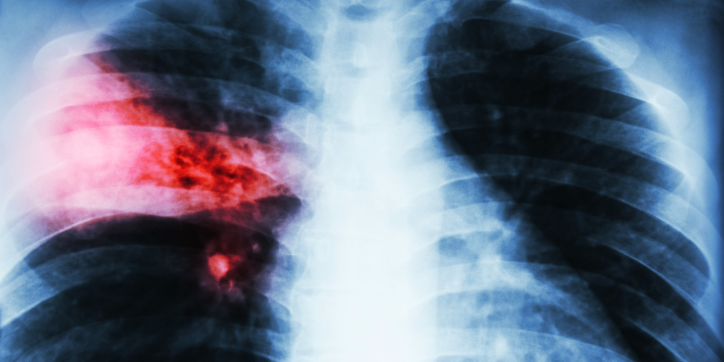 Chest X-ray showing lungs with a highlighted red area on the left side, indicating a possible infection, inflammation, or abnormality.