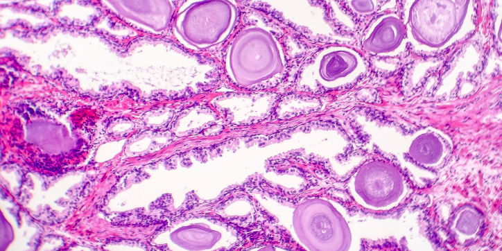 Microscopic view of tissue stained pink and purple, showing circular and oval structures, likely glands or ducts, surrounded by fibrous and cellular material.