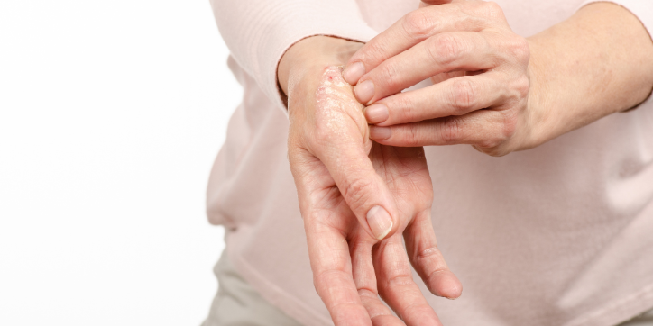 A person applying cream to red, irritated skin on the back of their hand, possibly treating a skin condition such as eczema or psoriasis.