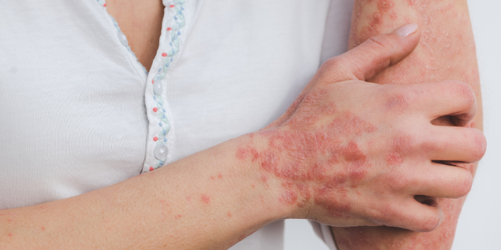 A person wearing a white shirt has red, scaly patches on their hand and forearm, suggesting a skin condition like psoriasis. They are gently holding their affected arm.