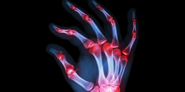 X-ray image of a human hand with red highlights on the joints, indicating inflammation or arthritis, against a black background.