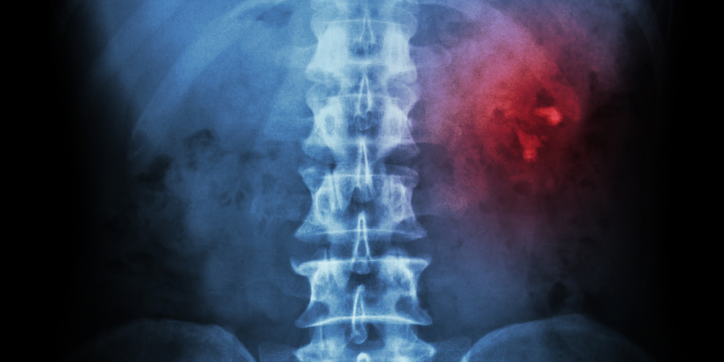 X-ray image of a human lower spine with a highlighted red area on the right side, suggesting possible abnormality or injury in that region.