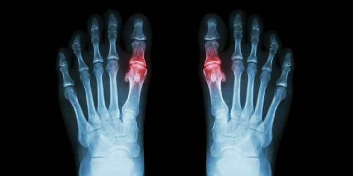 X-ray image of two feet, showing inflammation or abnormalities highlighted in red at the joints of the big toes, possibly indicating a medical condition such as gout or arthritis.