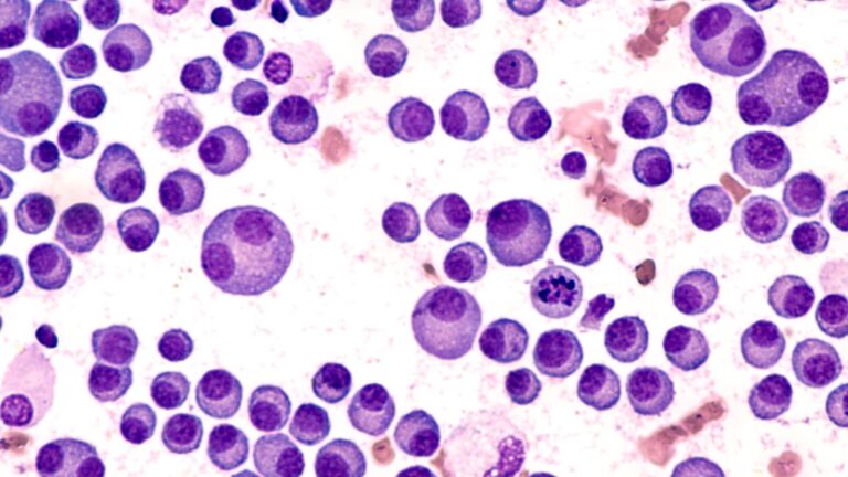 Microscopic view of purple-stained cells with round nuclei scattered across a light pink background, showing variations in cell size, typical of a bone marrow smear.