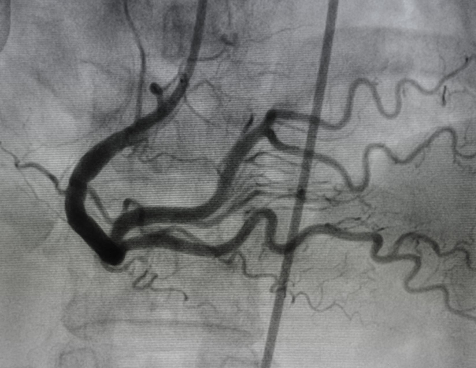 Black and white angiogram image showing the coronary arteries of the heart with a clear view of blood vessels; a catheter is visible on the right side of the image.