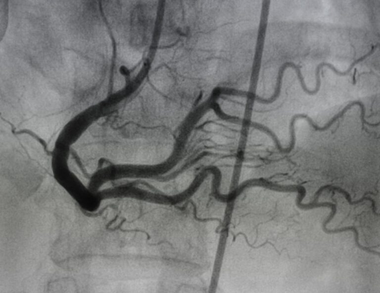 An angiogram showing the coronary arteries of the heart, with visible contrast dye highlighting the blood vessels for medical imaging and diagnosis.