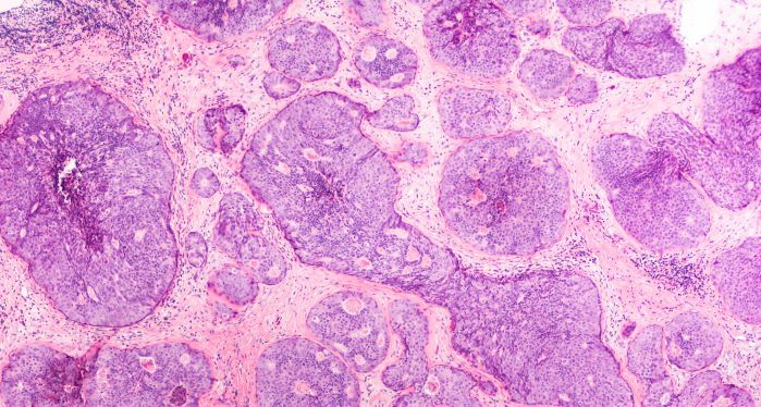 Microscopic image showing clusters of purple and pink cells, likely a tissue sample stained for examination, displaying various sized circular and irregular cell formations.