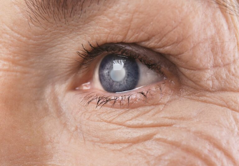 Close-up of an older person's blue eye with a cloudy white spot on the pupil, surrounded by wrinkles, indicating a possible eye condition such as cataract.