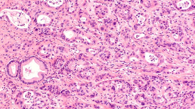 Microscopic image of tissue stained purple and pink, showing clusters of densely packed cells with visible nuclei, glandular structures, and irregular patterns typical of histopathology slides.