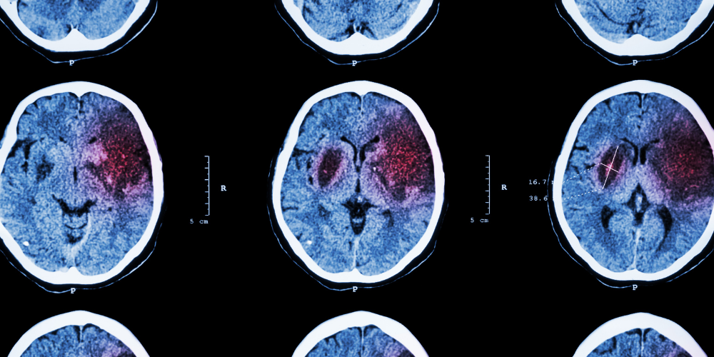 Multiple brain CT scans show abnormal red-highlighted areas, possibly indicating haemorrhage or stroke, on the left side of the brain. The images are arranged in a grid with black backgrounds and white outlines.