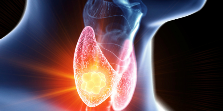 Digital illustration of a human neck in profile, highlighting the thyroid gland with a glowing, inflamed area suggesting thyroid disease or cancer.