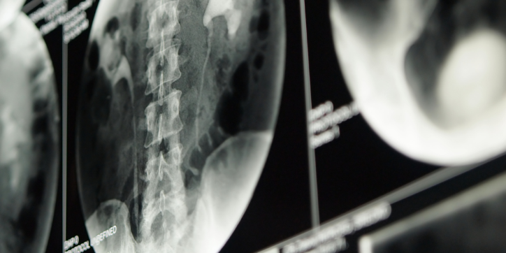 A close-up of an X-ray image showing a human spine and pelvis, with additional blurred medical images in the background.